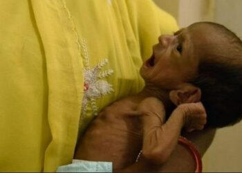 भारत में कुपोषण समाप्त करने हेतु स्वयंसेवी संस्थाओं एवं सरकार को मिलकर करने होंगे प्रयास